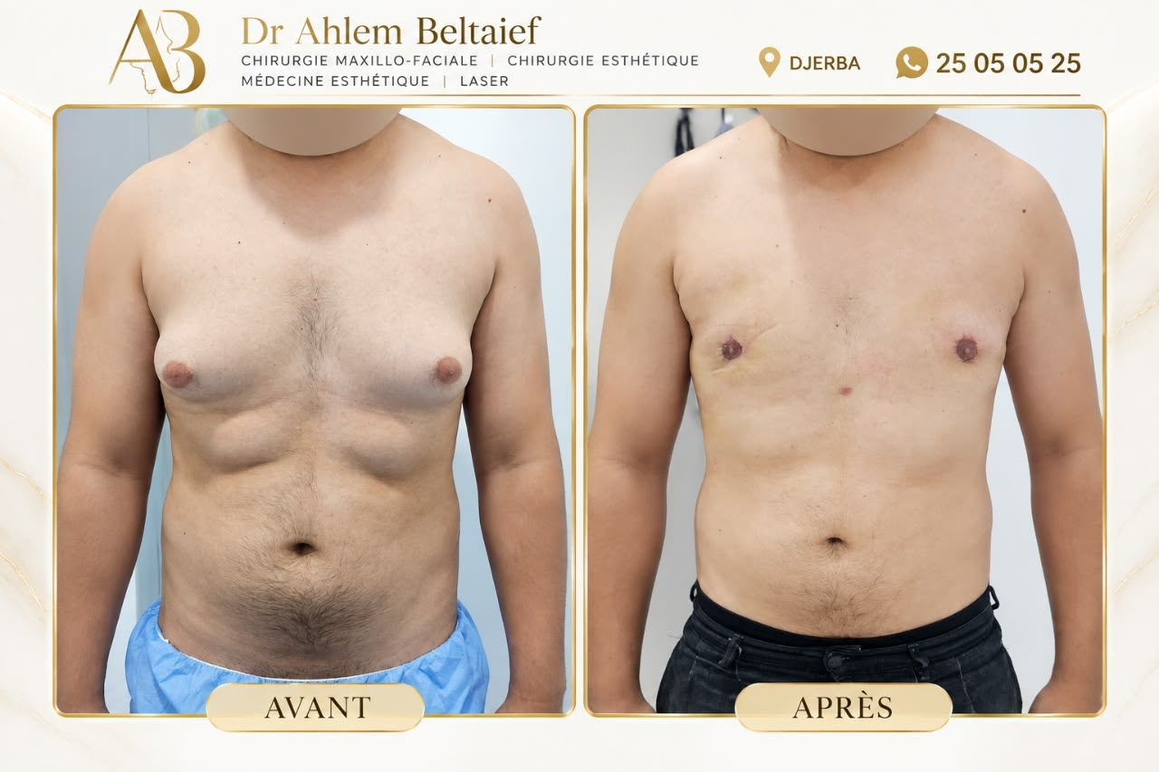 Avant / après chirurgie de la gynécomastie
