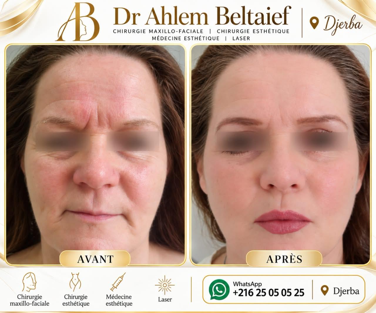Avant / après lifting cervico-facial, vue de face